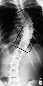 Scoliosis may be functional or congenital