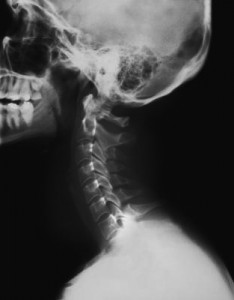lordosis-cervical
